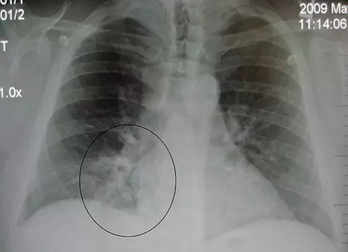 Tüdőfibrózis